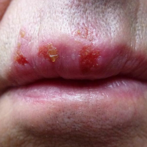 7 myths about herpes