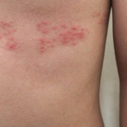 5 Ways to Deal with Shingles Nerve Pain