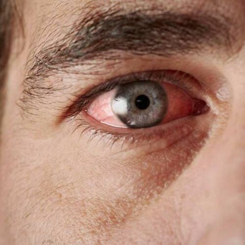 Common Causes of Blood Vessel Burst in the Eye