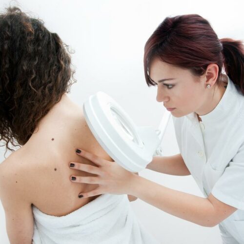 Common Signs and Symptoms of Melanoma