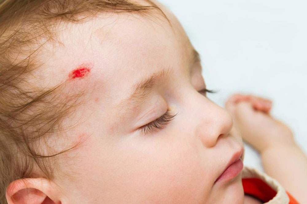 Common head injury symptoms in adults and children