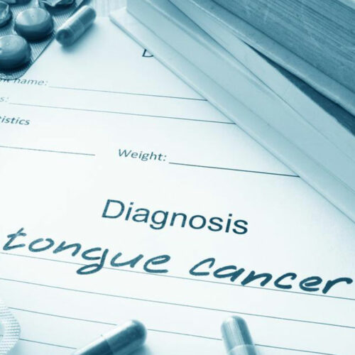 Common symptoms of tongue cancer