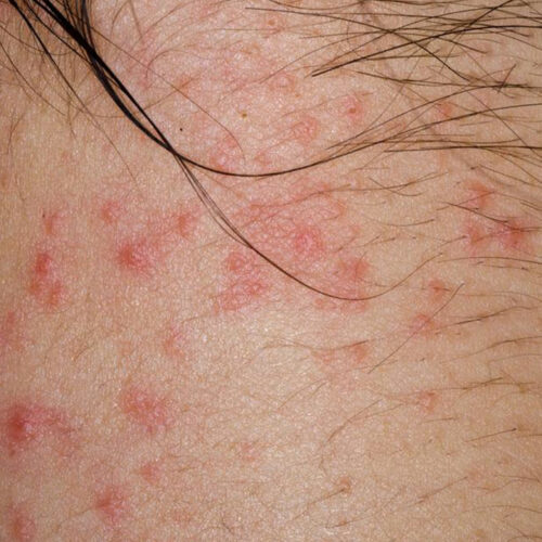 Curious about atopic dermatitis? Here&#8217;s what you need to know