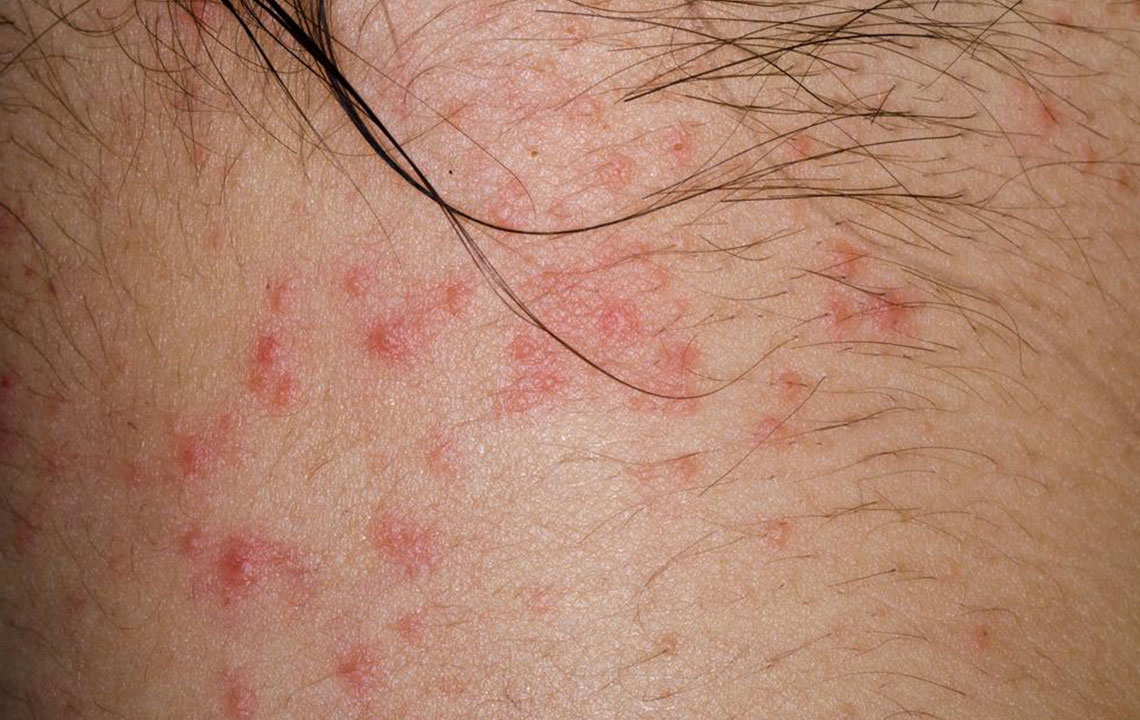 Curious about atopic dermatitis? Here&#8217;s what you need to know