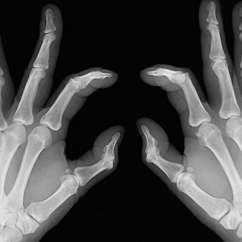 Early signs of rheumatoid arthritis and how to catch them