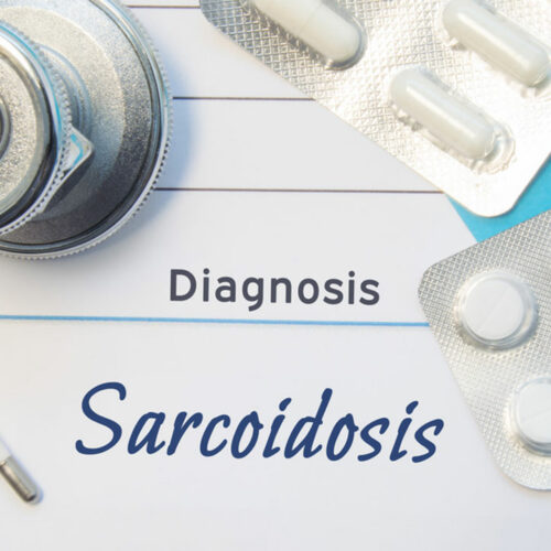 Sarcoidosis risk factors you should know about