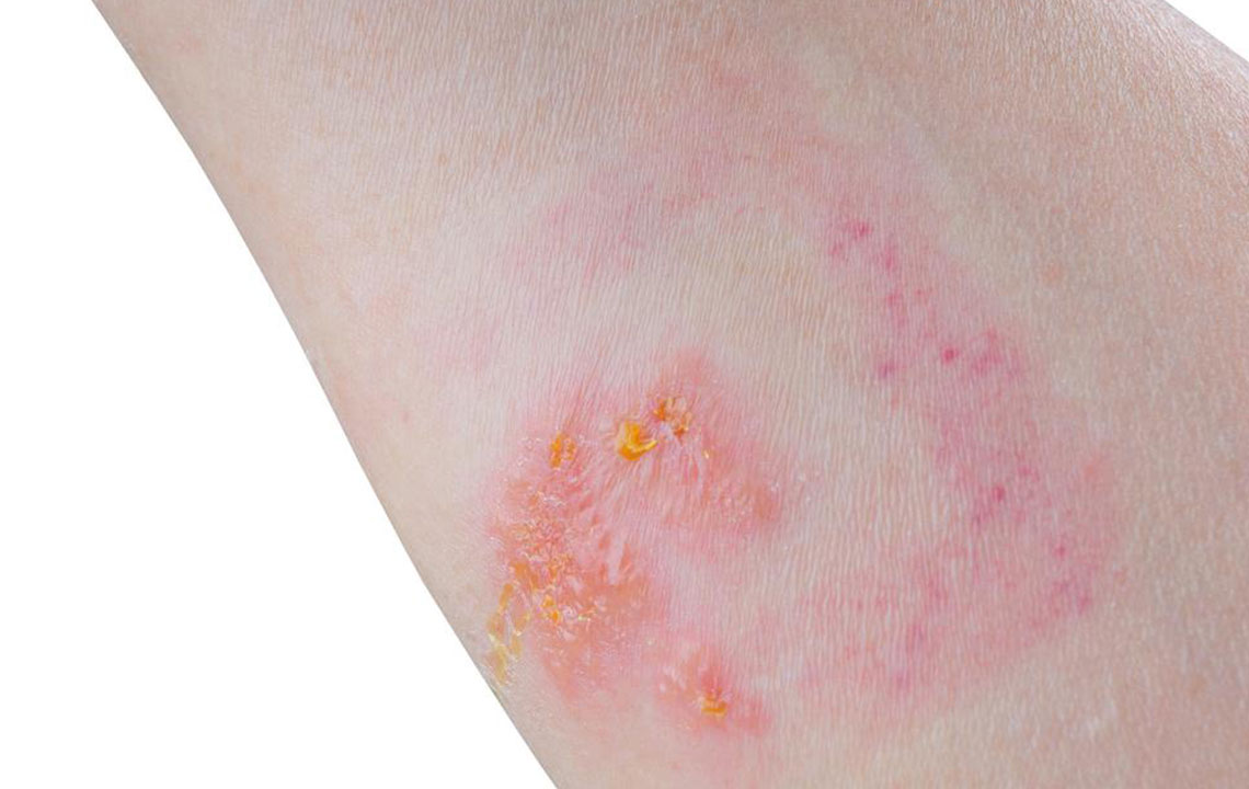 Skin Rash: Which condition is it?