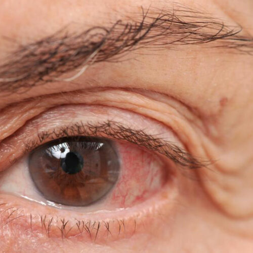 Ways of dealing with chronic dry eye disease