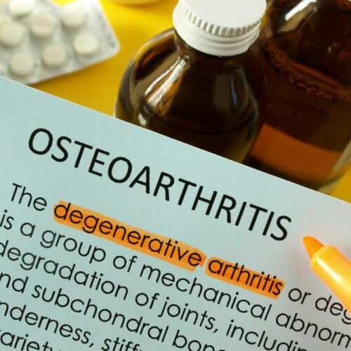 What are the treatment options for managing osteoarthritis