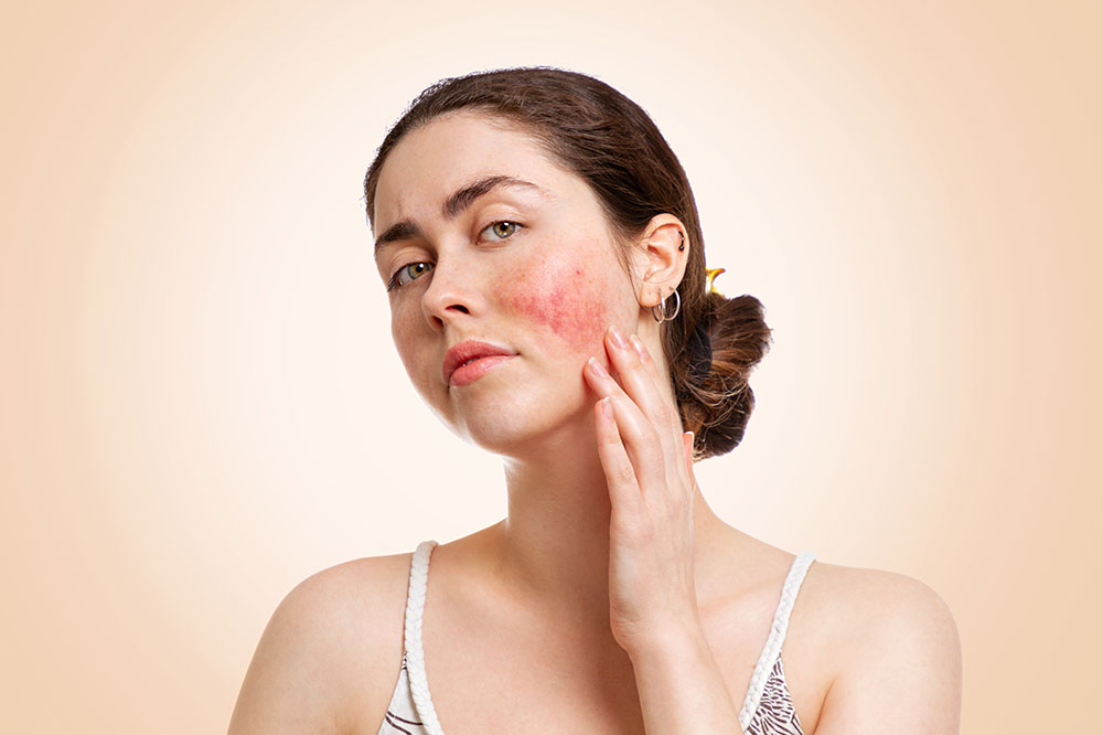 Type of rosacea and how the skin condition can be treated