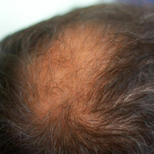 8 Effective Home Remedies for Thinning Hair