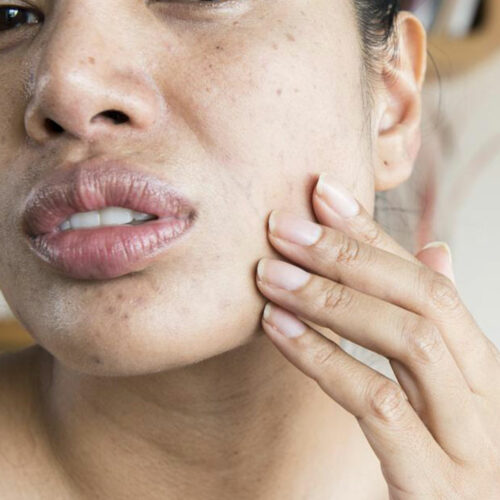 9 Symptoms of Lupus Women Should Know About