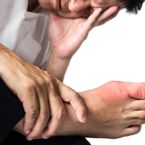 Common Risks and Causes of Gout