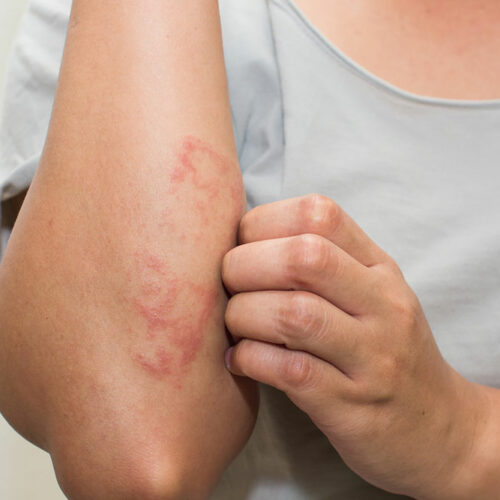 Common Types and Treatments of Eczematous Dermatitis