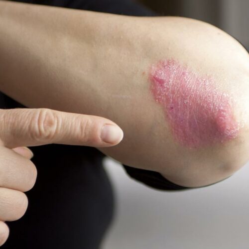 Causes of psoriasis that one needs to be aware of