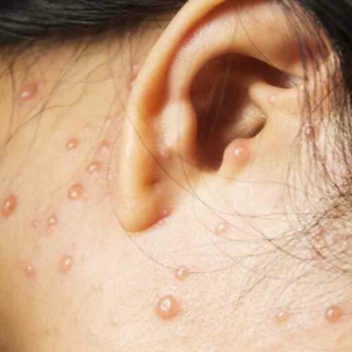 All You Need to Know About Shingles