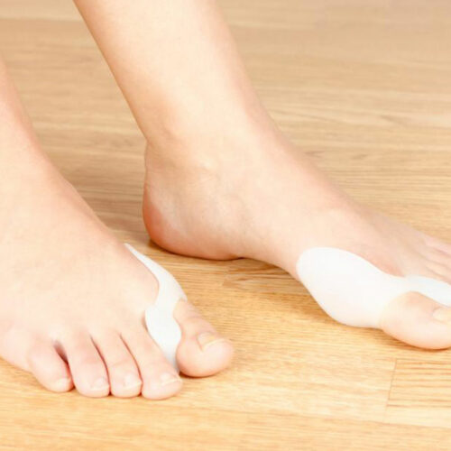 Bunion Treatment &#8211; All You Need to Know