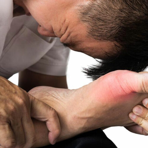 Different Treatment Plans for Gout Pain Relief and Prevention of Gout Attacks