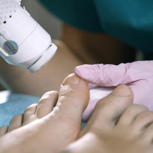 Essential Facts about Nail Fungus Cure