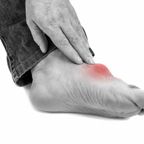 Everything You Need to Know About the Best Gout Treatments