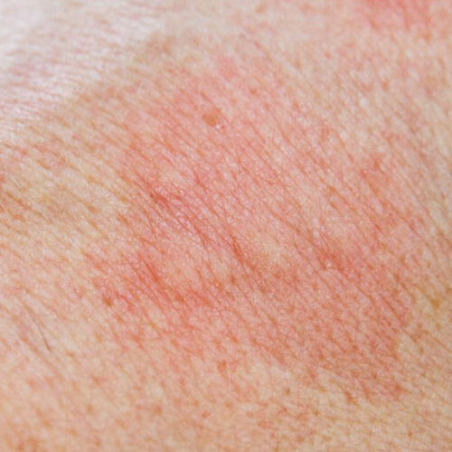 Know about the 5 Types of Skin Rashes