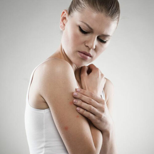 Here Are a Few Things to Know about Eczema Treatments