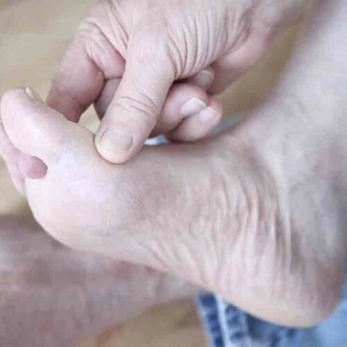 Managing Gout Foot Pain Effectively