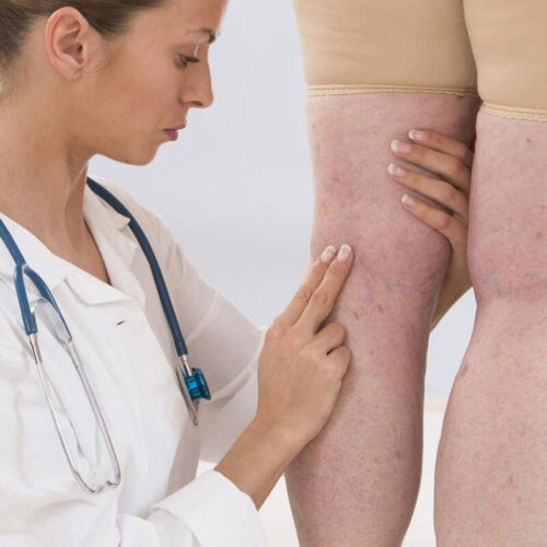 Standard Methods Used for the Treatment of Deep Vein Thrombosis