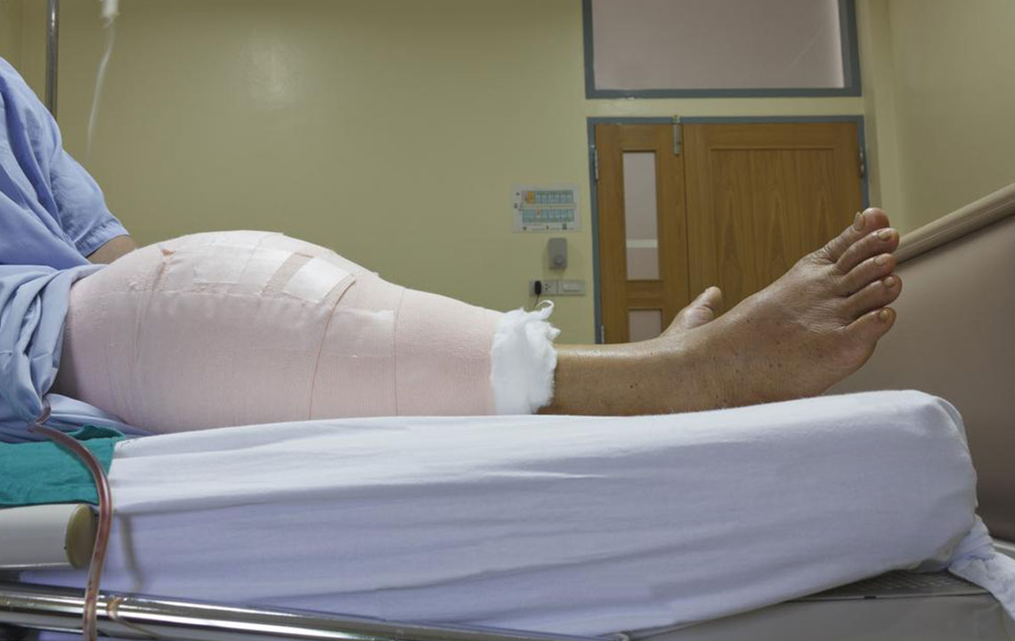 What You Need To Know About Knee Replacement Surgery