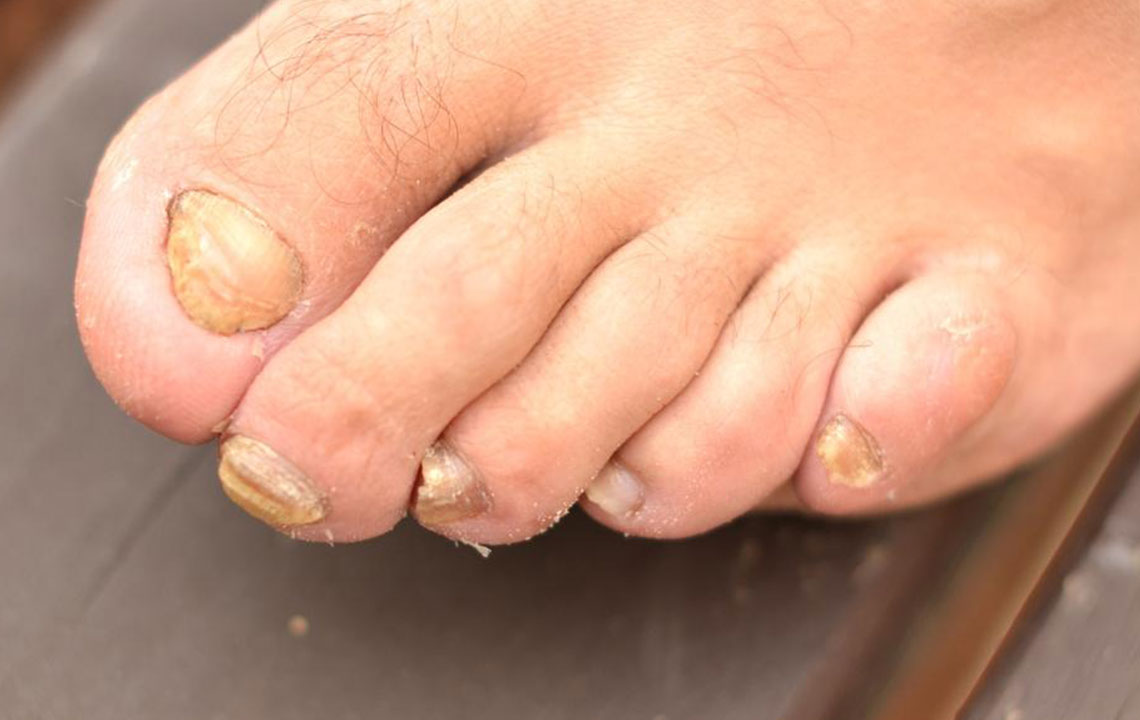 Toenail Fungus &#8211; Causes, Symptoms and Treatment