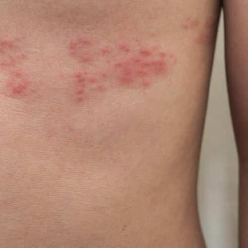 Top 3 Simple Treatments for Shingles You Need to Know