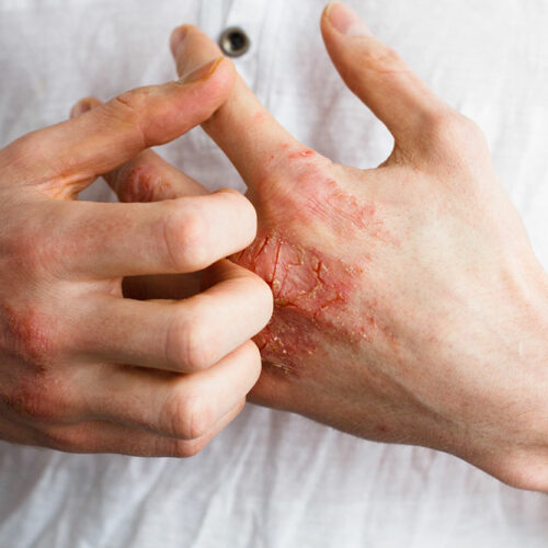 Things You Need to Know about Eczema