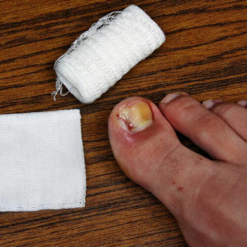 Tips to Cure and Prevent Toenail Fungus