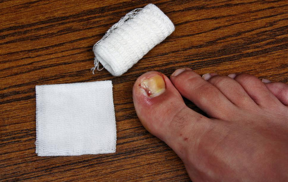 Tips to Cure and Prevent Toenail Fungus