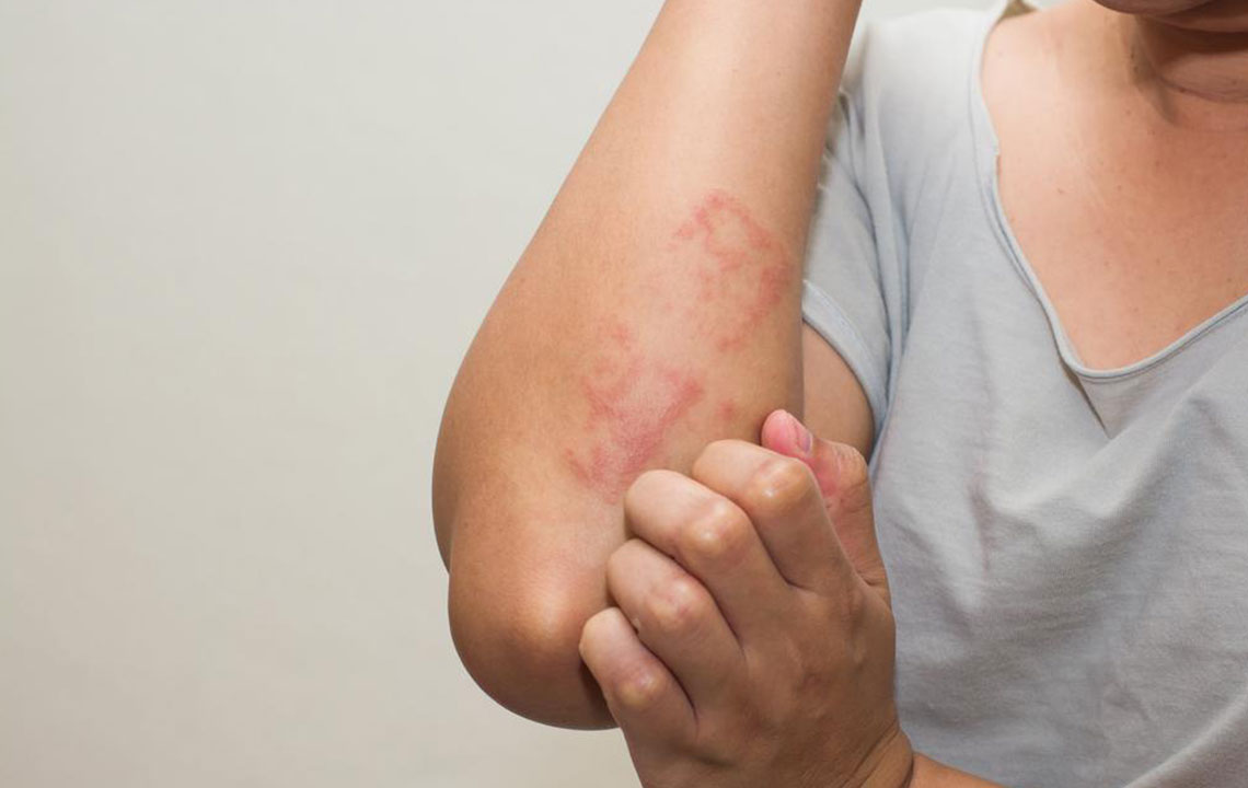 Treatment Options for Eczema You Should Know About