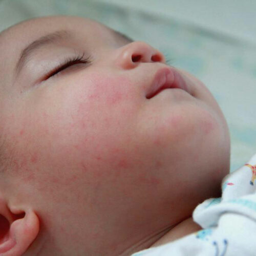 Understanding the Signs and Symptoms of Baby Eczema