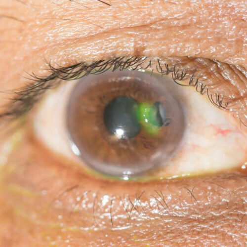 Various eye diseases and their symptoms