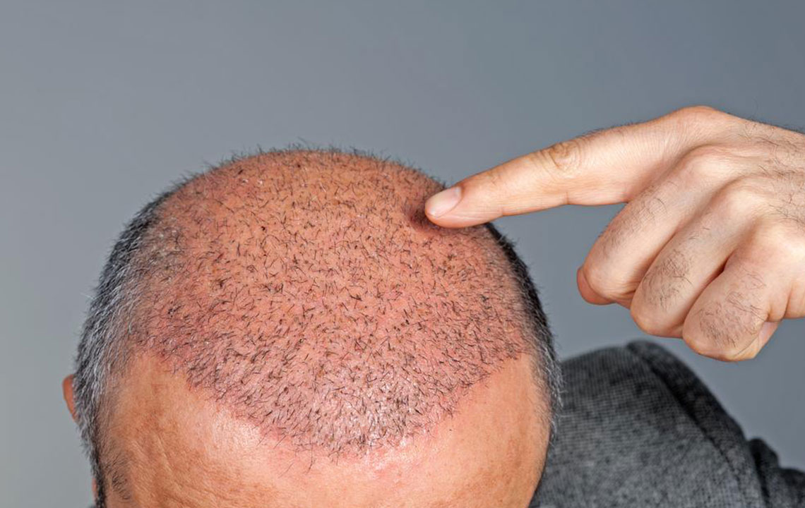 Hair Transplant Cost and Procedure